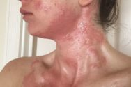 аллергический ожог от ядовитого плюща
